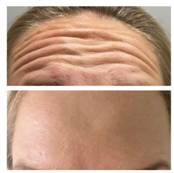 Skin tightening near me