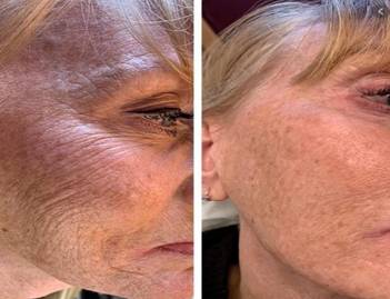 Facial resurfacing techniques