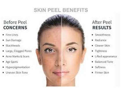Peels are chemical solutions