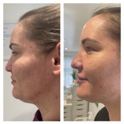 Skin lifting in Heathfield