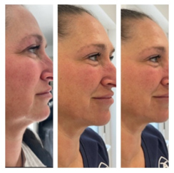 Skin Rejuvenating Device Heathfield