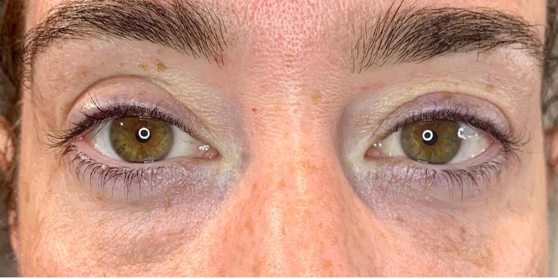 eyelid ptosis post botox Ringmer