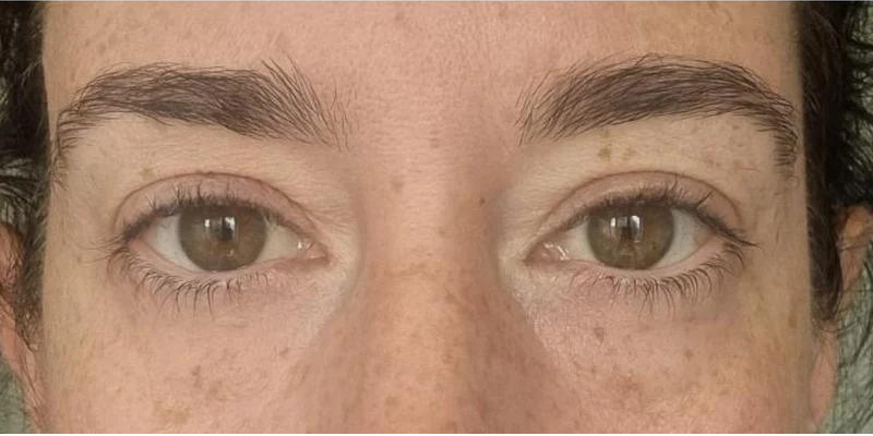 eyelid ptosis post botox Ringmer