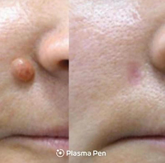 mole-1 mole